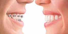Is Invisalign Right For You?