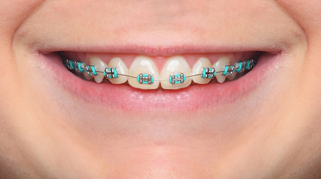 Best Braces Near Elgin