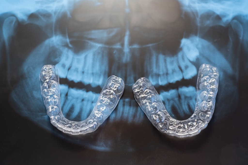 Invisalign Columbia Sc
