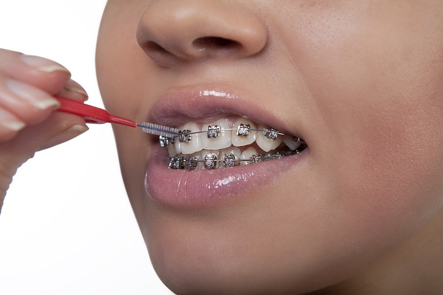Stained Teeth From Braces