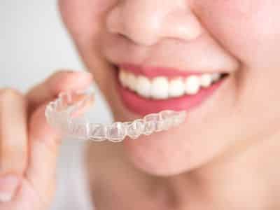 Whiter Smile With Invisalign