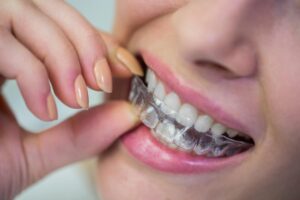 Invisalign Braces