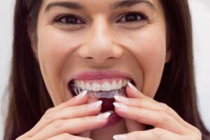 Whiter Smile With Invisalign