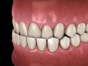 Early Orthodontic